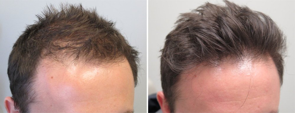 Dr.Han hairloss transformacija