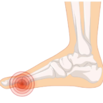 Bolovi u zglobovima, solucija na prirodan način!