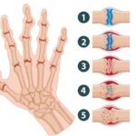 Artritis: Uzroci, simptomi i kako ublažiti bolove