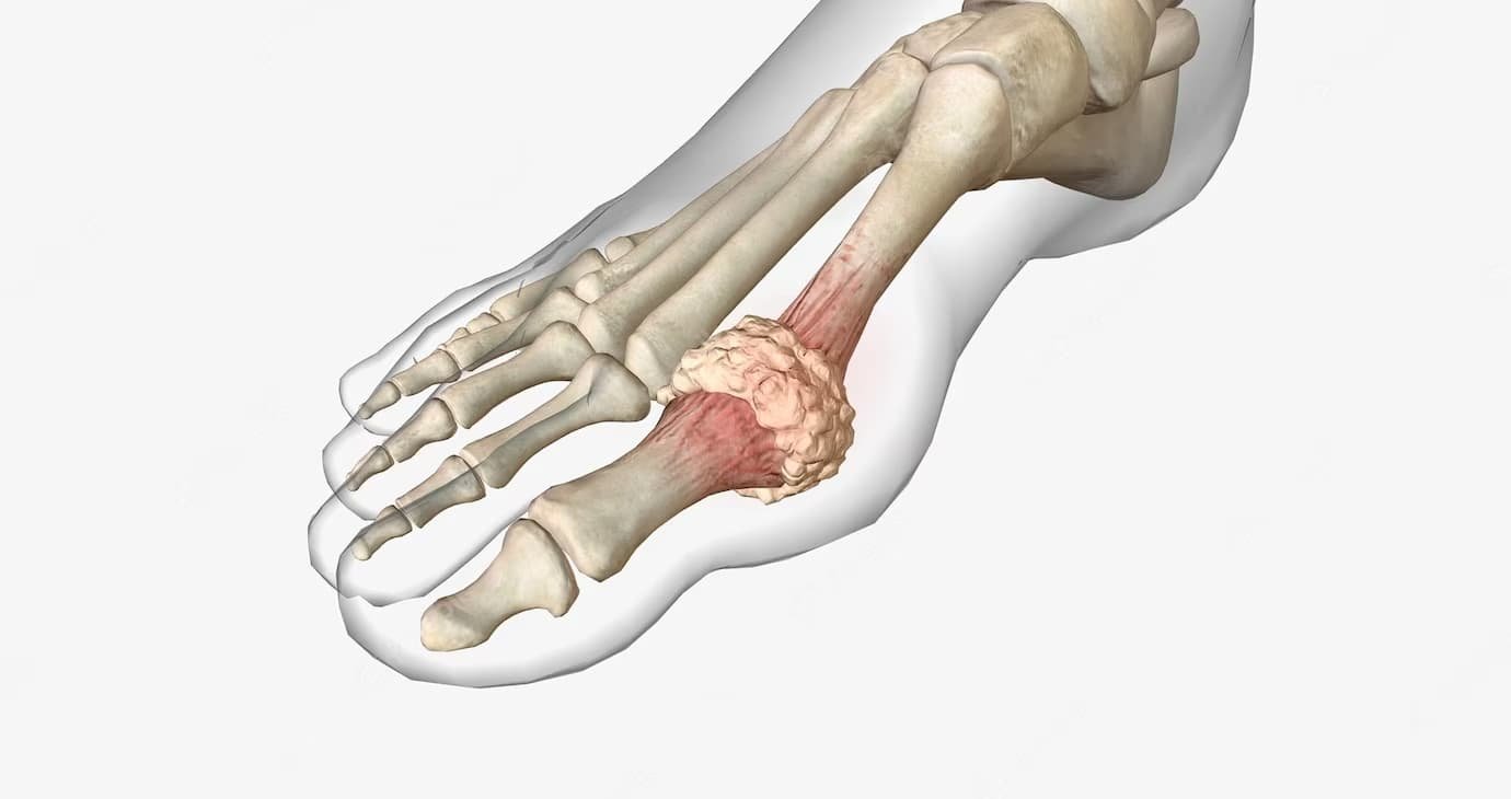 Tendinitis liječenje