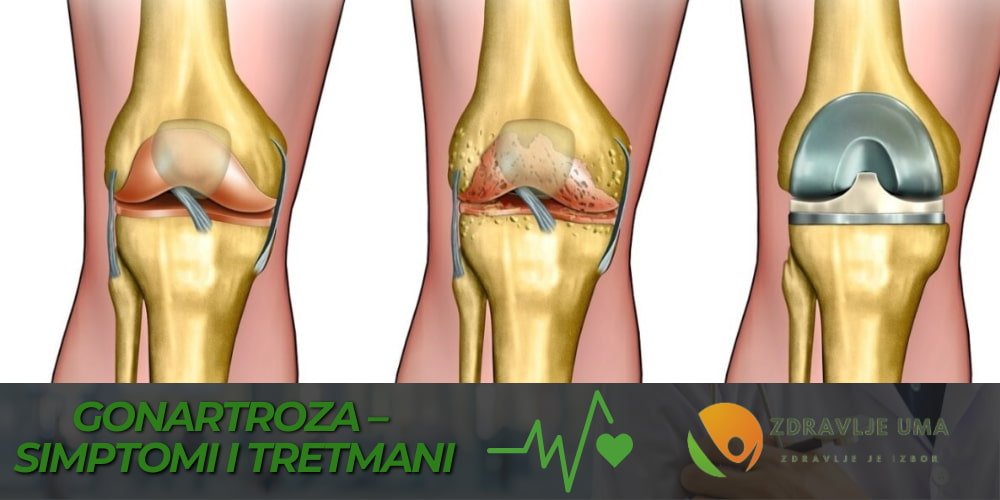 Gonartroza iskustva