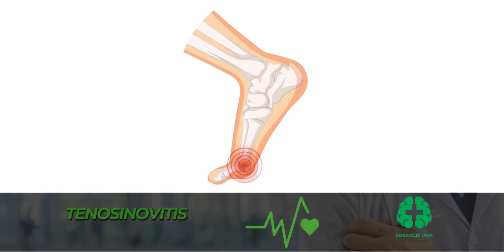 Tenosinovitis bolest iskusva