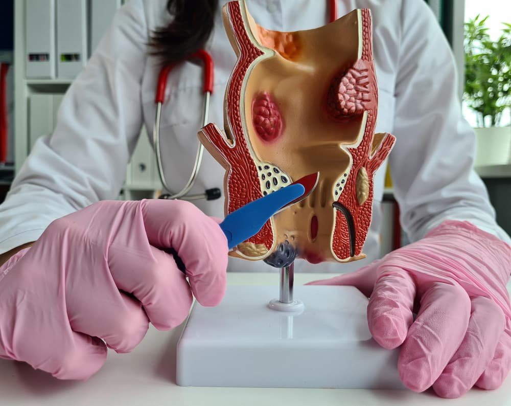 Koliko traje liječenje hemoroida